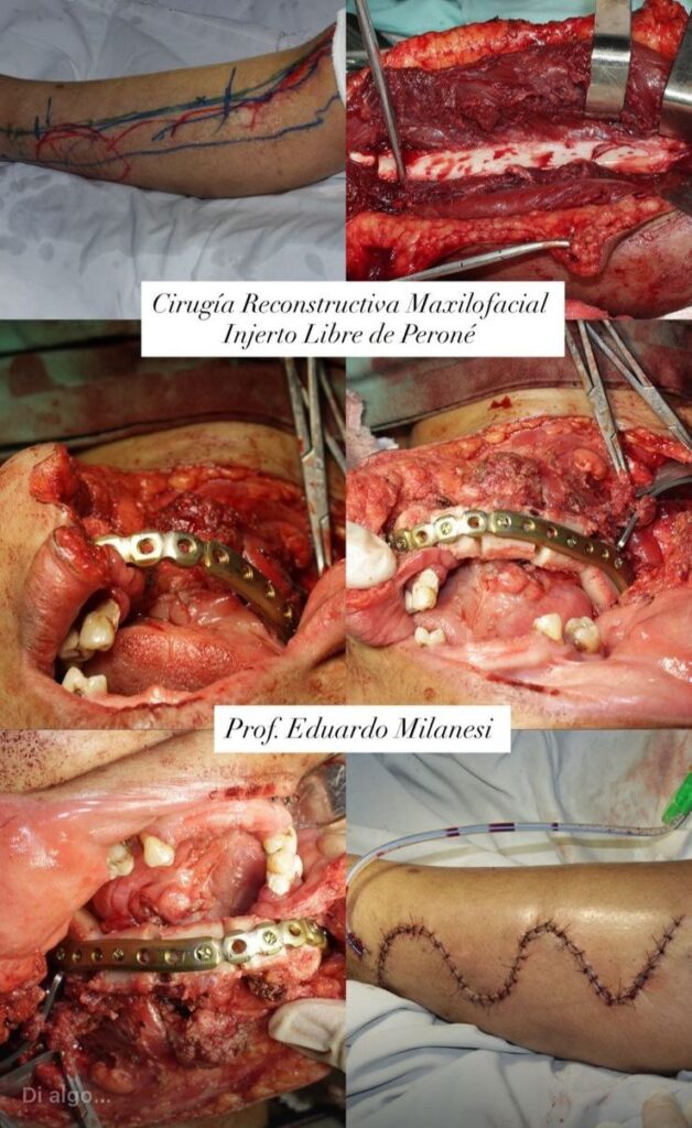 Injerto Libre de Peroné - Cirugía Maxilofacial - Cirujano Maxilofacial - Centro de Cirugía y Traumatología Maxilofacial Bolivia