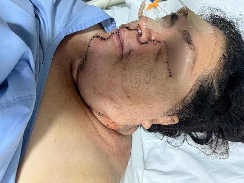 Primera Cirugía Exitosa de Injerto Vascular Doble en Bolivia Centro de Cirugía Bucal y Traumatología Maxilofacial en Bolivia