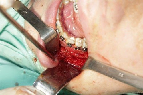 Quistes Maxilares - Cirujano Maxilofacial - Centro de Cirugía y Traumatología Maxilofacial Bolivia