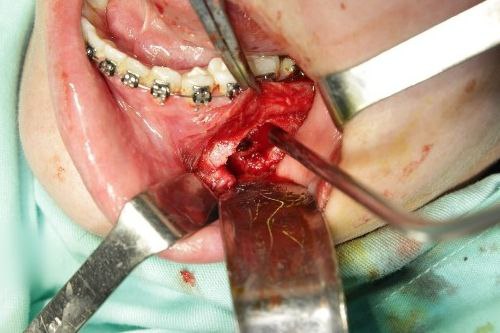 Quistes Maxilares - Cirujano Maxilofacial - Centro de Cirugía y Traumatología Maxilofacial Bolivia