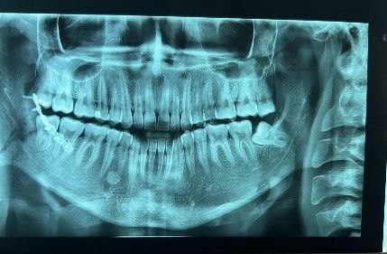 Fracturas de Mandíbula - Cirujano Maxilofacial - Centro de Cirugía y Traumatología Maxilofacial Bolivia