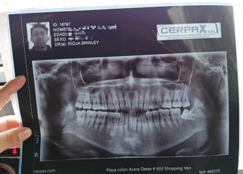 Fracturas de Mandíbula - Cirujano Maxilofacial - Centro de Cirugía y Traumatología Maxilofacial Bolivia