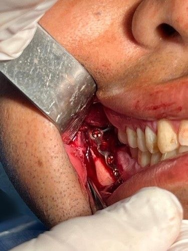 Fracturas de Mandíbula - Cirujano Maxilofacial - Centro de Cirugía y Traumatología Maxilofacial Bolivia