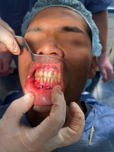Fracturas de Mandíbula - Cirujano Maxilofacial - Centro de Cirugía y Traumatología Maxilofacial Bolivia