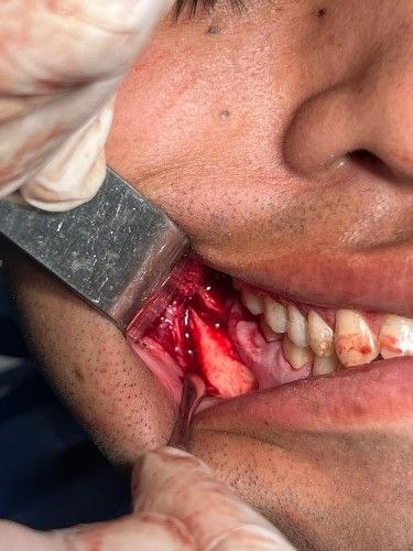 Fracturas de Mandíbula - Cirujano Maxilofacial - Centro de Cirugía y Traumatología Maxilofacial Bolivia