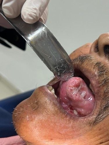 Tratamiento de Cáncer Bucal en Bolivia - Cirujano Maxilofacial – Centro de Cirugía y Traumatología Maxilofacial Bolivia