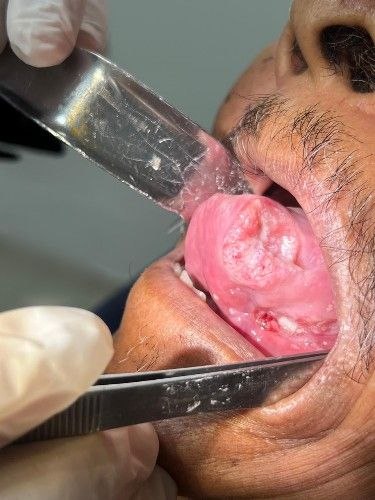 Tratamiento de Cáncer Bucal en Bolivia - Cirujano Maxilofacial – Centro de Cirugía y Traumatología Maxilofacial Bolivia
