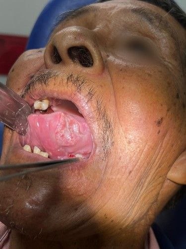 Tratamiento de Cáncer Bucal en Bolivia - Cirujano Maxilofacial – Centro de Cirugía y Traumatología Maxilofacial Bolivia