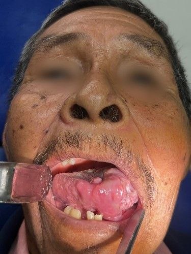 Tratamiento de Cáncer Bucal en Bolivia - Cirujano Maxilofacial – Centro de Cirugía y Traumatología Maxilofacial Bolivia