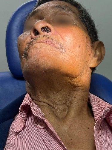 Tratamiento de Cáncer Bucal en Bolivia - Cirujano Maxilofacial – Centro de Cirugía y Traumatología Maxilofacial Bolivia