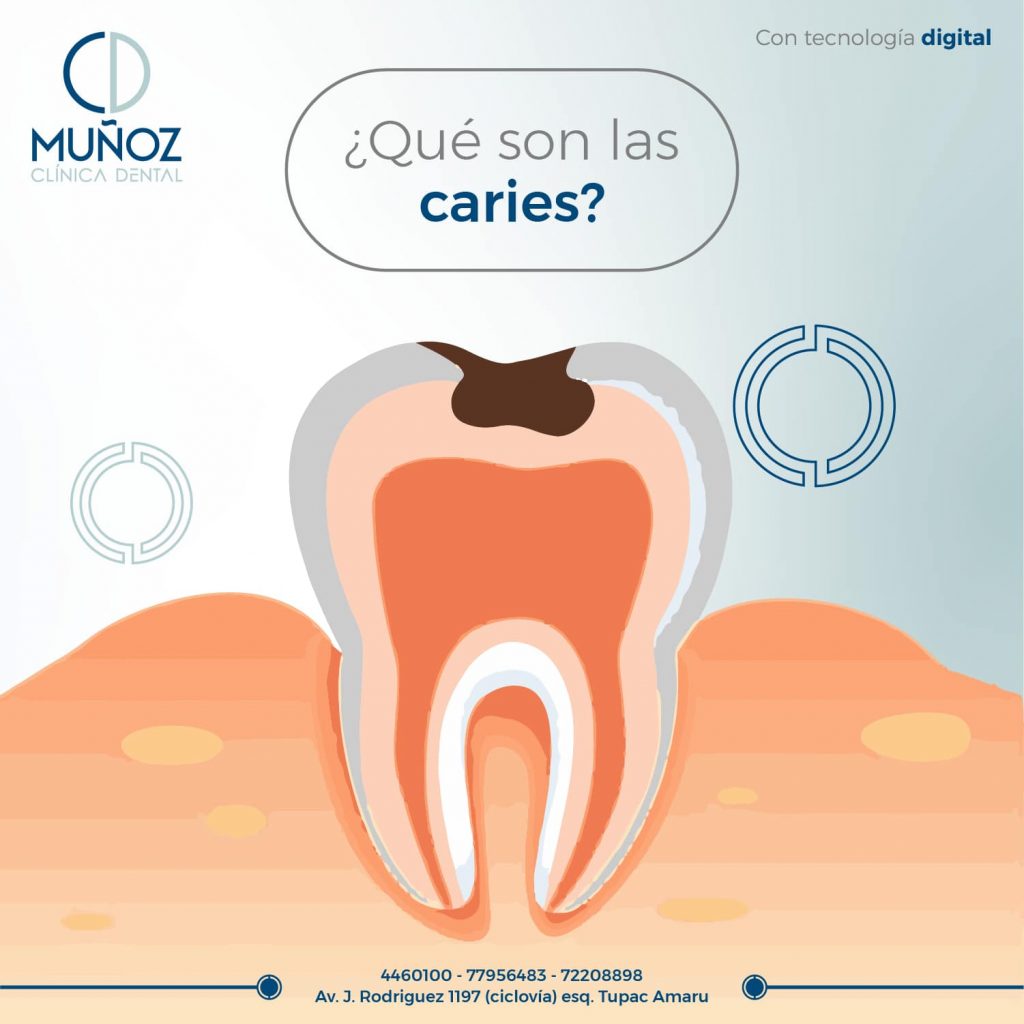 ¿Que son Las Caries? Clínica Dental Muñoz Cochabamba